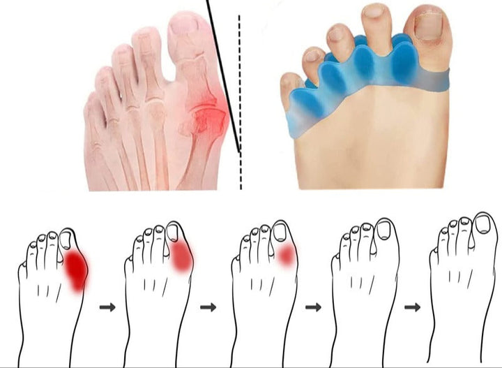 Toe separator